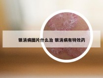 银消病图片什么治 银消病有特效药