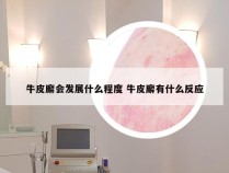 牛皮廨会发展什么程度 牛皮廨有什么反应