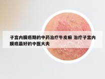 子宫内膜癌期的中药治疗牛皮癣 治疗子宫内膜癌最好的中医大夫