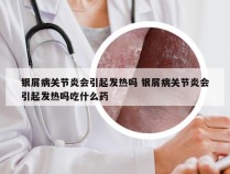 银屑病关节炎会引起发热吗 银屑病关节炎会引起发热吗吃什么药