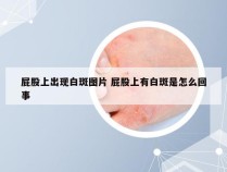 屁股上出现白斑图片 屁股上有白斑是怎么回事