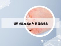 银屑病起皮怎么办 银屑病爆皮