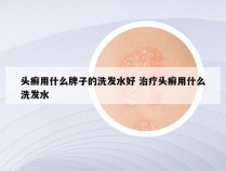 头癣用什么牌子的洗发水好 治疗头癣用什么洗发水