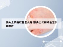 额头上长癣红色怎么办 额头上长癣红色怎么办图片