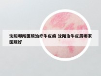 沈阳哪所医院治疗牛皮癣 沈阳治牛皮屑哪家医院好