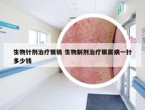 生物针剂治疗银销 生物制剂治疗银屑病一针多少钱