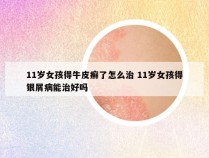 11岁女孩得牛皮癣了怎么治 11岁女孩得银屑病能治好吗