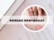 银屑病放血后 银屑病中医放血治疗