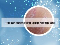 汗斑与白斑的图片区别 汗斑和白斑有何区别