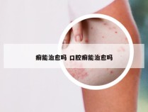 癣能治愈吗 口腔癣能治愈吗