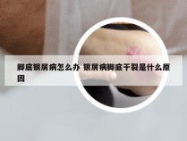 脚底银屑病怎么办 银屑病脚底干裂是什么原因