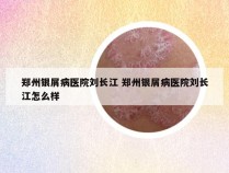 郑州银屑病医院刘长江 郑州银屑病医院刘长江怎么样