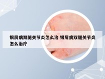 银屑病双腿关节炎怎么治 银屑病双腿关节炎怎么治疗