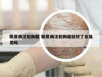 银屑病注射胸腺 银屑病注射胸腺肽好了会复发吗