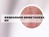 银屑病的白斑会好吗 银屑病留下的白斑多久能好