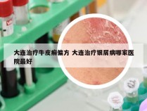 大连治疗牛皮癣偏方 大连治疗银屑病哪家医院最好