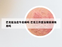 巴克能治愈牛皮癣吗 巴克三件套治银屑病有用吗