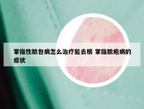 掌指性脓包病怎么治疗能去根 掌指脓疱病的症状