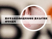 重庆专治银屑病的医院有哪些 重庆治疗银屑病专科医院