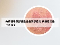 头癣属于深部感染还是浅部感染 头癣感染是什么样子