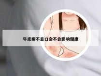 牛皮癣不忌口会不会影响健康