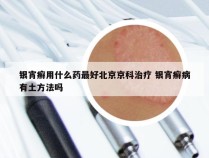 银宵癣用什么药最好北京京科治疗 银宵癣病有土方法吗