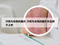 汗斑与白斑的图片 汗斑与白斑的图片长在脖子上的