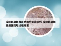 成都银康银肖屑病医院能治俞吗 成都银康银屑病医院地址在哪里