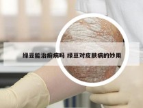 绿豆能治癣病吗 绿豆对皮肤病的妙用