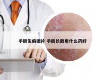 手脚生癣图片 手脚长藓用什么药好