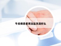 牛皮癣患者用浴盐洗澡好么