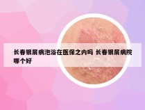 长春银屑病泡浴在医保之内吗 长春银屑病院哪个好