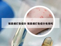 银屑病打免疫针 银屑病打免疫针有用吗