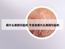 癣什么原因引起的 牛皮皮癣什么原因引起的