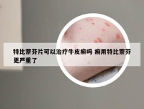 特比萘芬片可以治疗牛皮癣吗 癣用特比萘芬更严重了