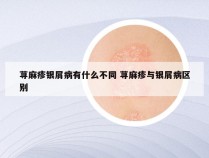 荨麻疹银屑病有什么不同 荨麻疹与银屑病区别