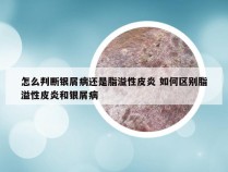 怎么判断银屑病还是脂溢性皮炎 如何区别脂溢性皮炎和银屑病