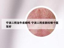 宁波二院治牛皮癣吗 宁波二院皮肤科哪个医生好