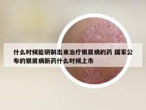 什么时候能研制出来治疗银屑病的药 国家公布的银屑病新药什么时候上市