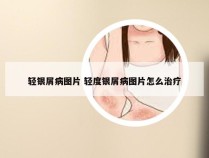 轻银屑病图片 轻度银屑病图片怎么治疗