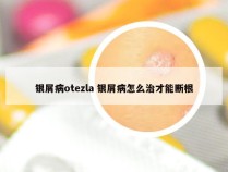 银屑病otezla 银屑病怎么治才能断根