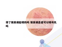 得了银屑病能喂奶吗 银屑病患者可以喂母乳吗