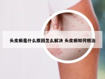 头皮癣是什么原因怎么解决 头皮癣如何根治