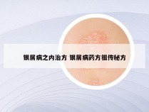 银屑病之内治方 银屑病药方祖传秘方