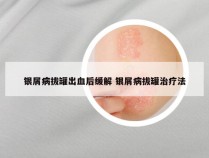 银屑病拔罐出血后缓解 银屑病拔罐治疗法