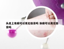 头皮上有癣可以用无极膏吗 体癣可以用无极膏吗