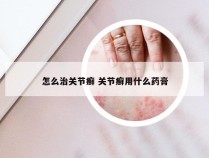 怎么治关节癣 关节癣用什么药膏