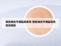 银屑病关节病临床表现 银屑病关节病临床表现有哪些