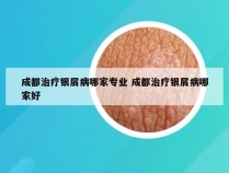 成都治疗银屑病哪家专业 成都治疗银屑病哪家好