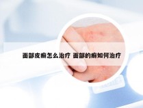 面部皮癣怎么治疗 面部的癣如何治疗